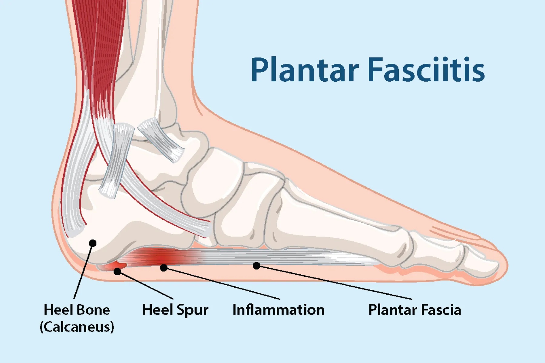 Fascitis plantar en Monterrey: por qué duele el talón y cómo tratarlo