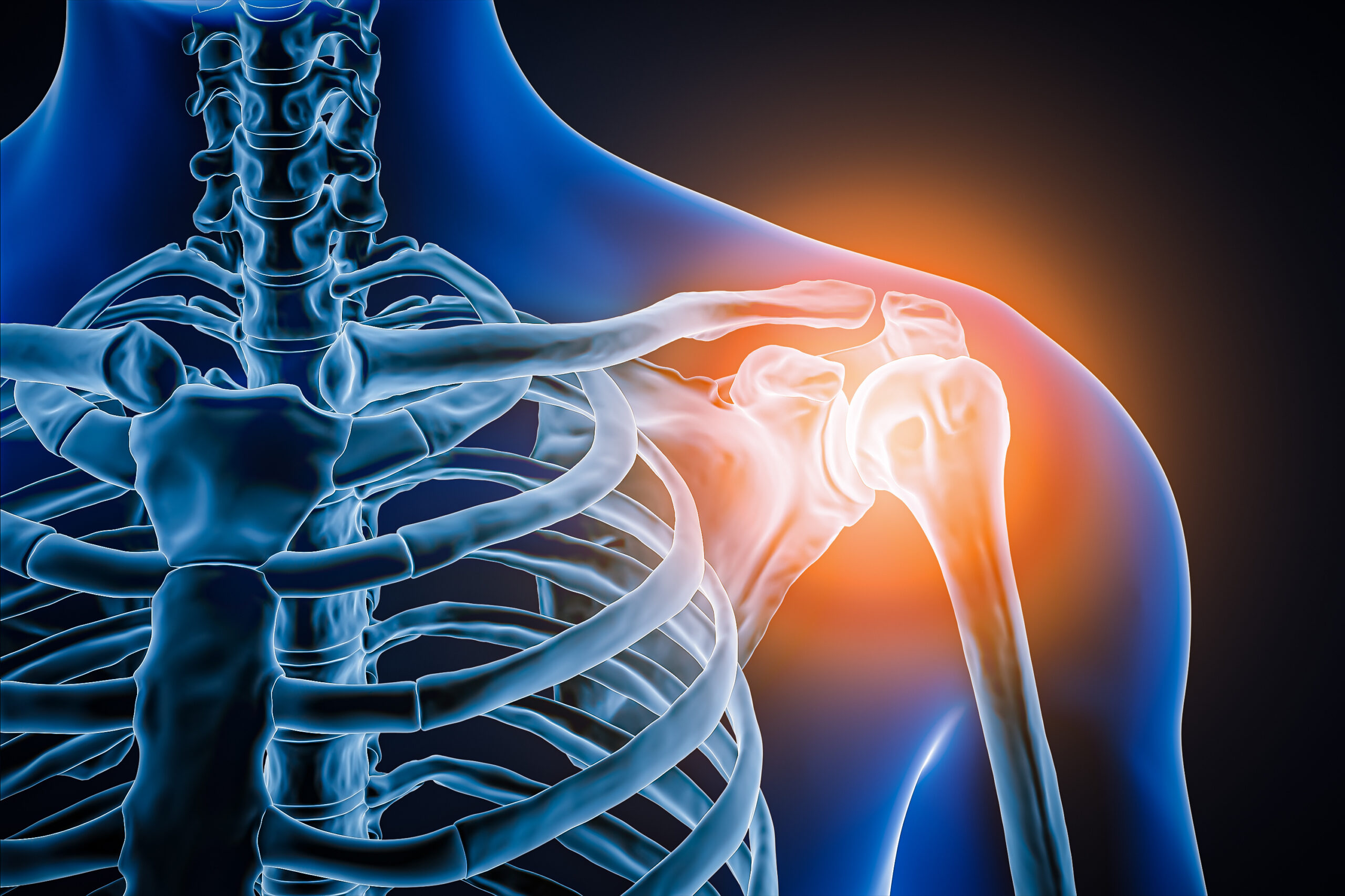 Lesiones de la articulación acromioclavicular: diagnóstico y opciones de tratamiento