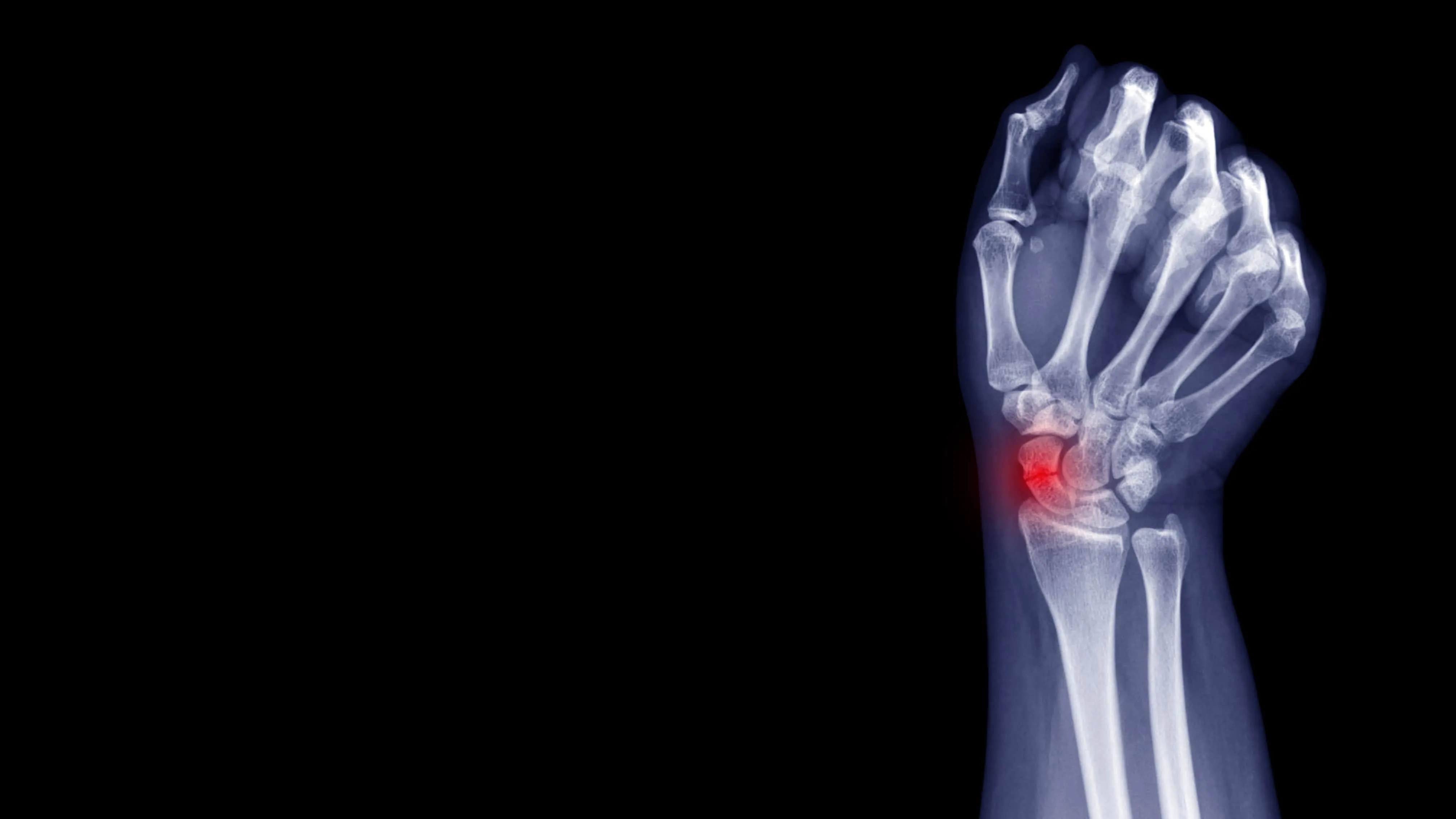 Fractura de muñeca: cuándo se necesita cirugía, tipos de fractura y tiempos de recuperación
