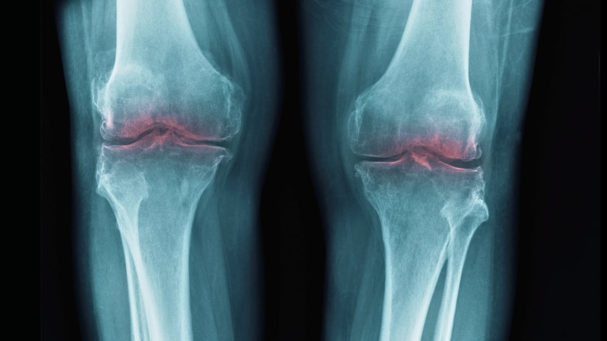Reemplazo de rodilla en Monterrey: señales de artrosis avanzada y opciones de tratamiento